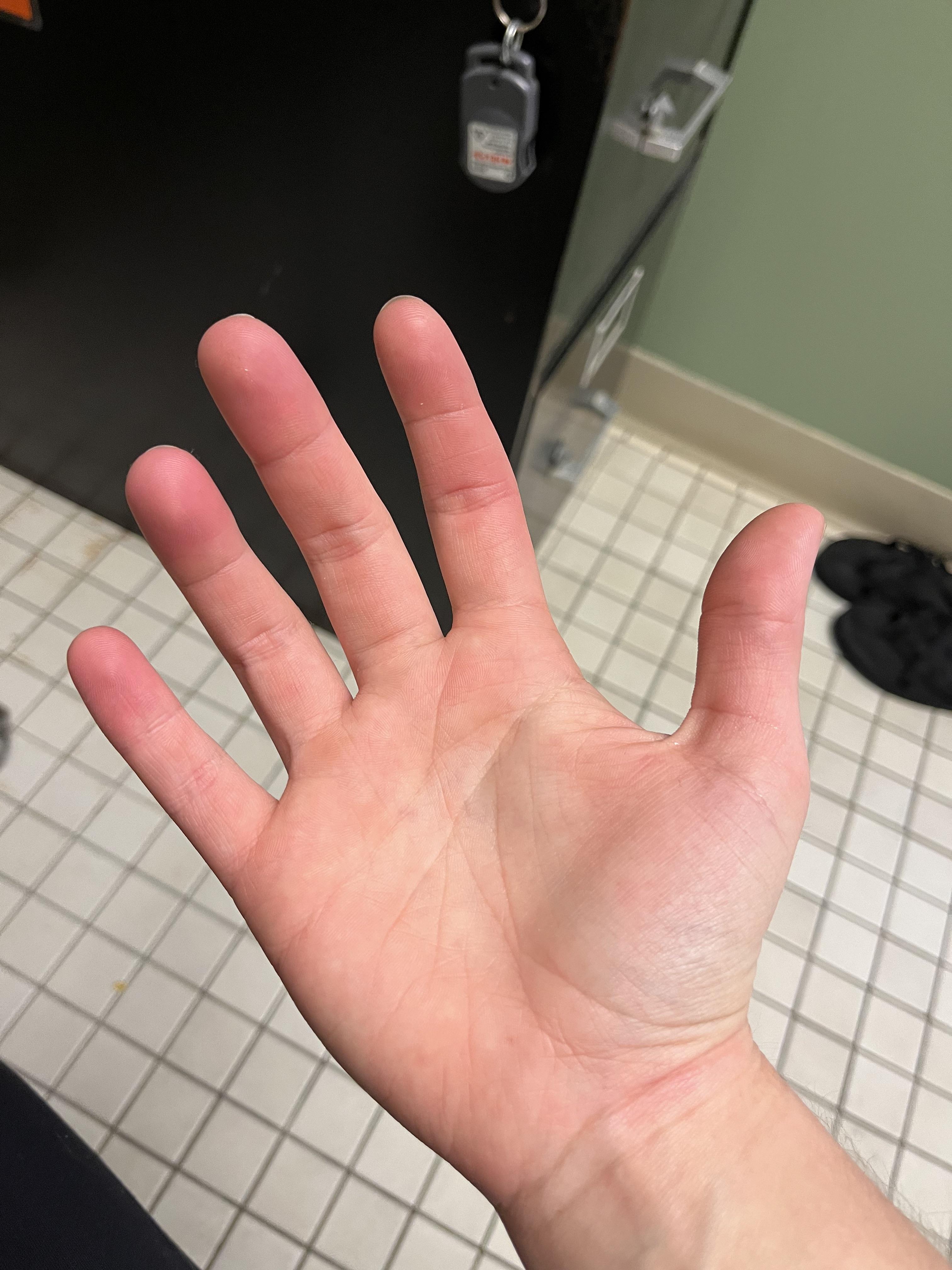 Why does my hand feel like it's burning: example and key details