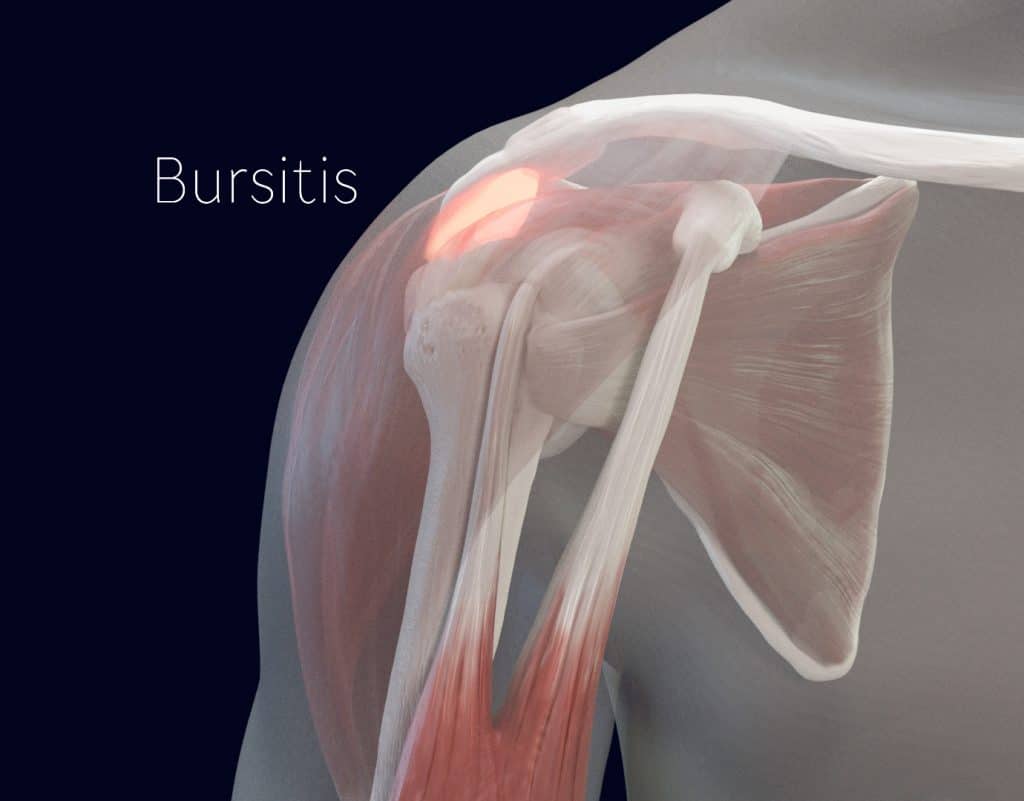 Why does my shoulder hurt when i lift my arm: visual explanation