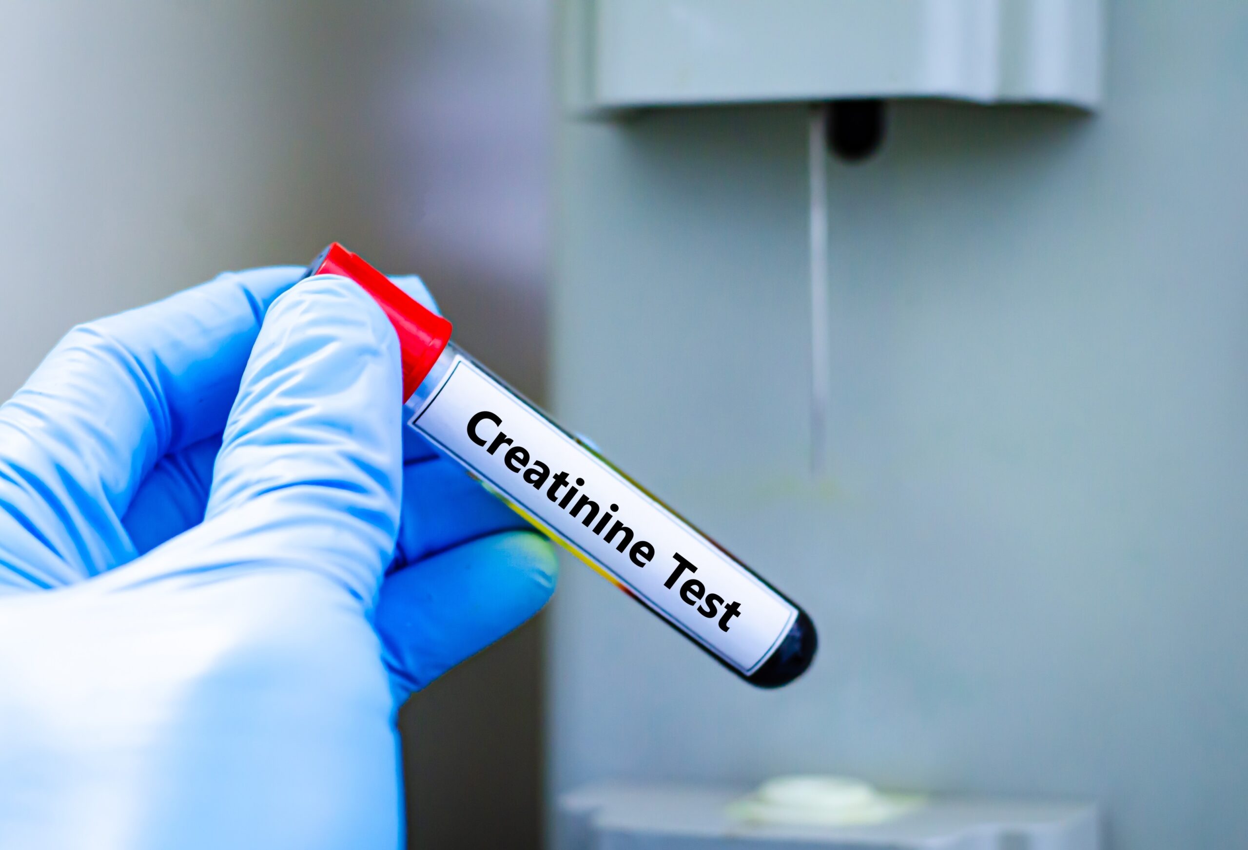What does it mean if your creatinine is high: visual explanation