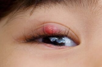 stye-bc04ea