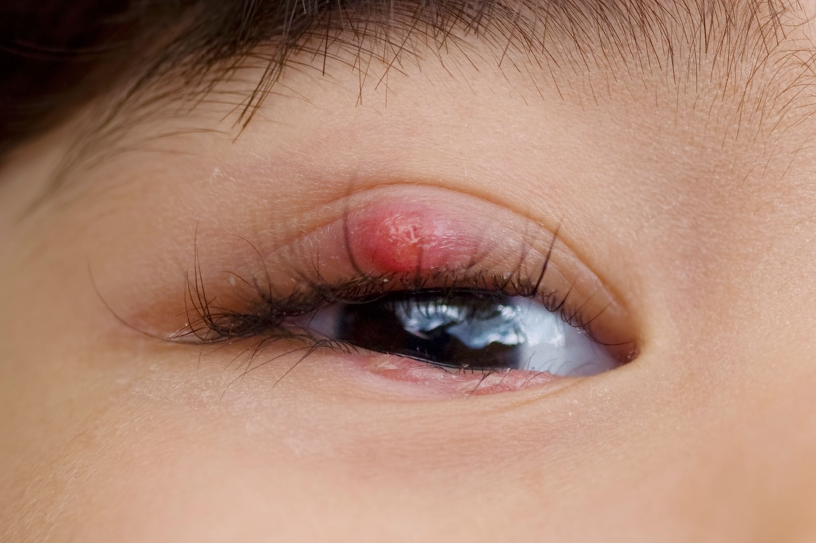 What happens if u pop a stye: main illustration