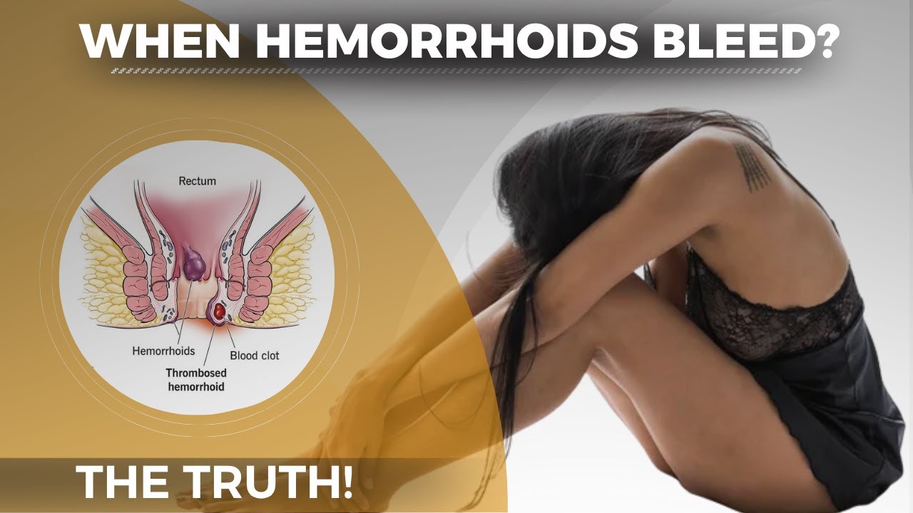 Is it bad when hemorrhoids bleed: example and key details