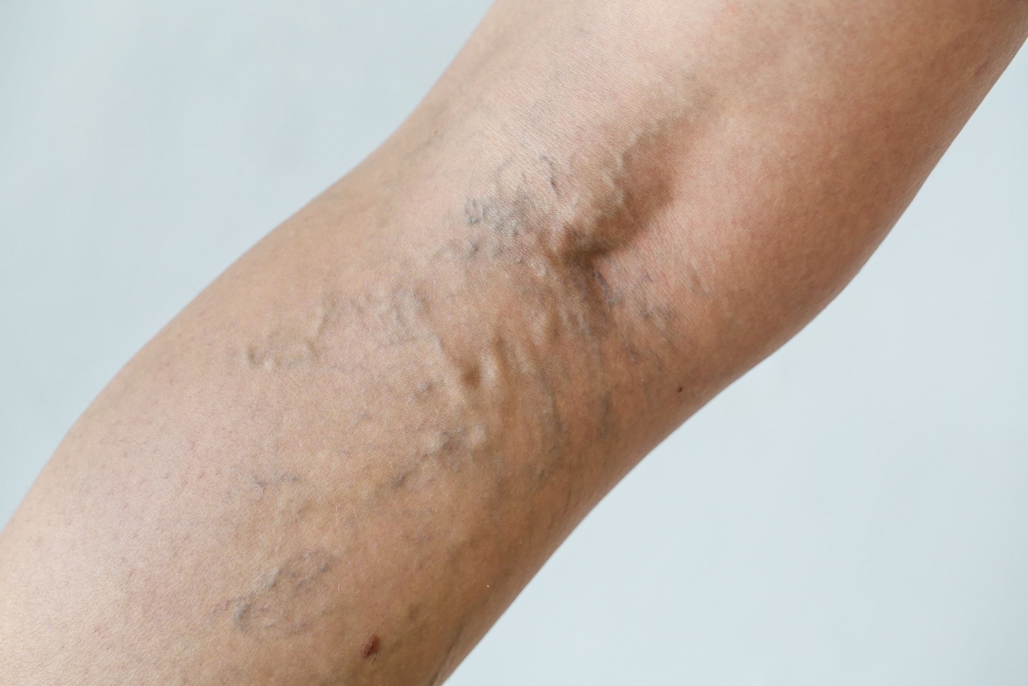 Why does my arm veins hurt: visual explanation