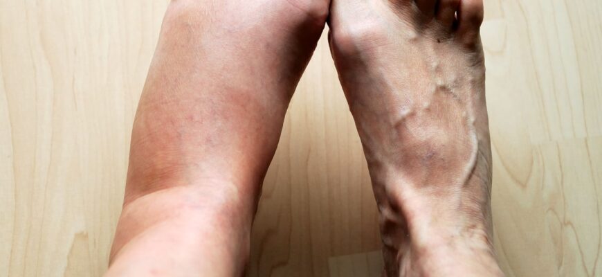 what-causes-swollen-feet