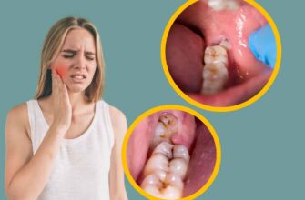 wisdom-tooth-pain