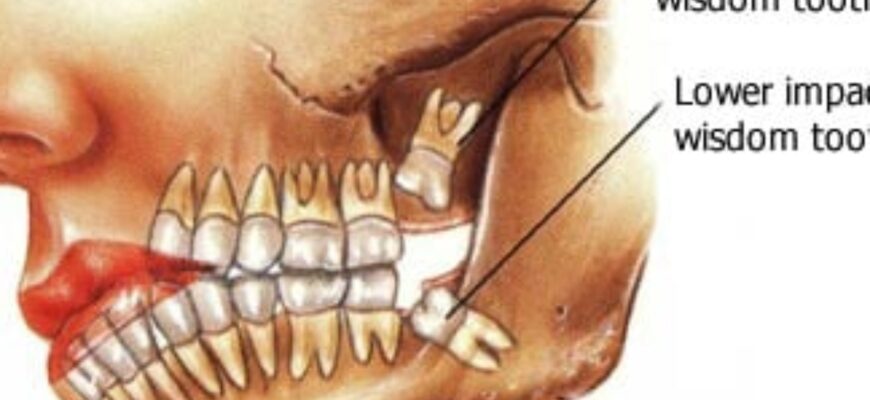 wisdom-tooth-surgery-austin-oral-surgery-1200x900