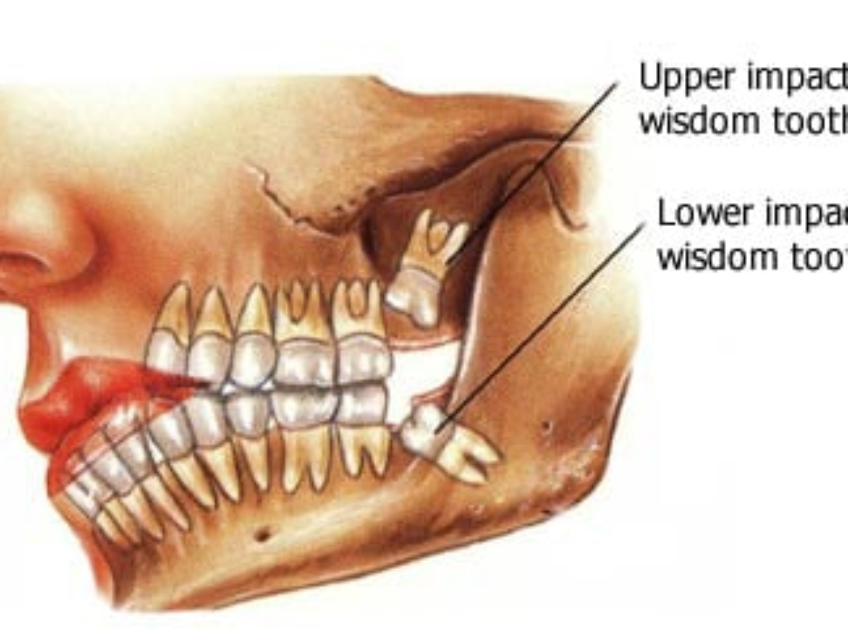 What happens if you never remove your wisdom teeth: main illustration